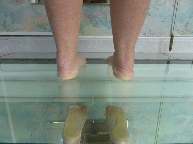 Pronation corrigée